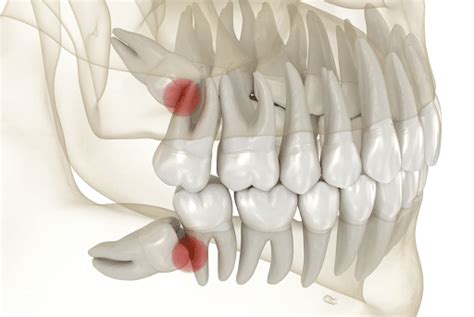 Wisdom Teeth Facts You May Not Know Absolute Dental