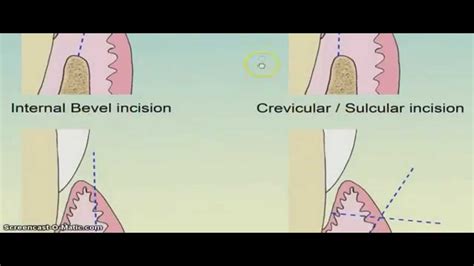How To Put Internal Bevel Incision Youtube
