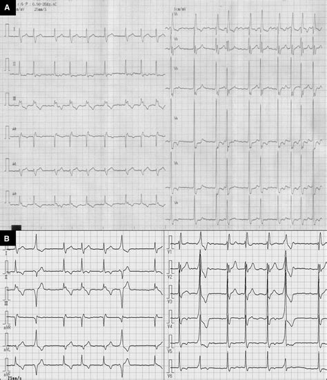 Wide Qrs Complexes In An Asymptomatic Elderly Man With Permanent Atrial