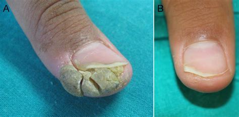 This article reviews the available methods of treatment for recalcitrant. Spontaneous Regression of a Recalcitrant Wart after ...