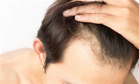 Testosterone And Hair Loss In Males Whats The Link