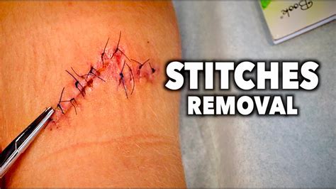Removing 13 Stitches From A Huge Leg Wound Dr Paul Youtube