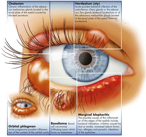 Whats The Difference Between A Meibomian Cyst And A Stye