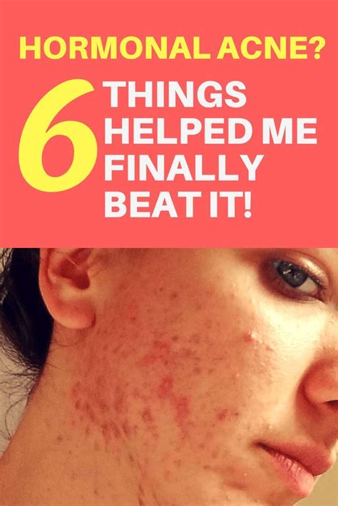 I Beat Hormonal Acne My 6 Powerful Little Secrets Acné Hormonal