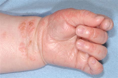 Atopic Eczema Clinical Review Gponline