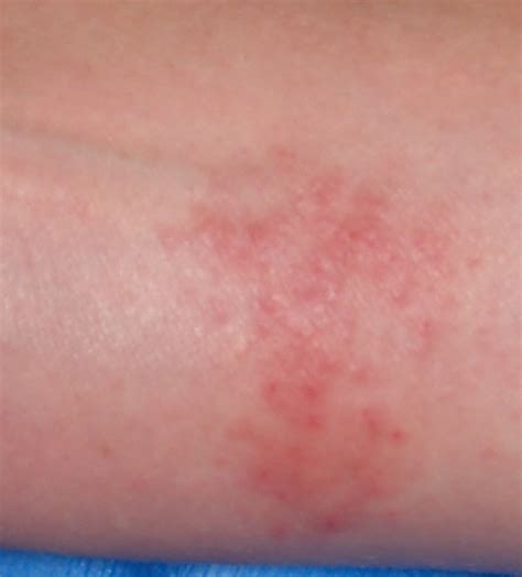The Gallery For Allergic Contact Dermatitis Arm