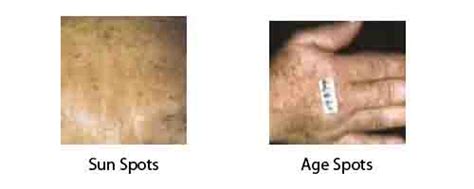 Causes And Treatment Of Brown Skin Spots Pictures And Brochures