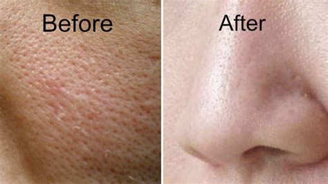There are many tips on how to clear pores on face, and some of them deserve attention, as they give a good result. How to Get Rid of Large Pores in 3 Days | Get Smooth ...