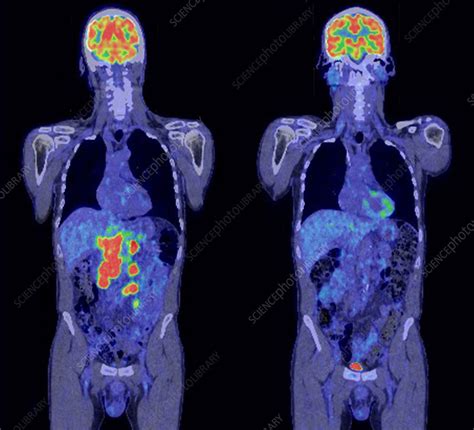 Diffuse Large B Cell Lymphoma Ct And Pet Scans Stock Image C054