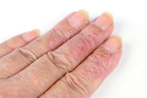 Can Eczema Affect Your Fingernails What You Need To Know Medovie