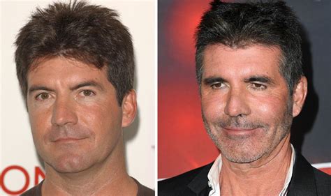 Simon Cowells Drastically Different Face Botox ‘too Much Filler