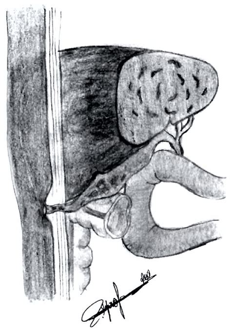 This Figure Is An Illustration Of Cholecystocutaneous Fistula It Shows