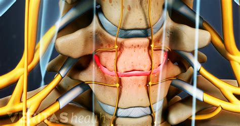 Degenerated Disc Disease Motus Physical Therapy