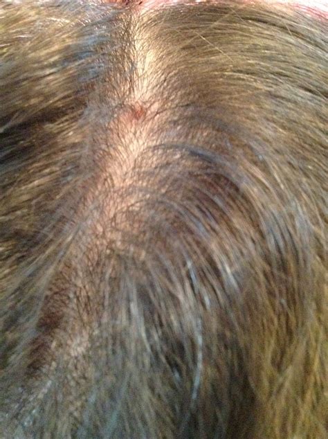 Red Spots On Scalp Pictures Photos