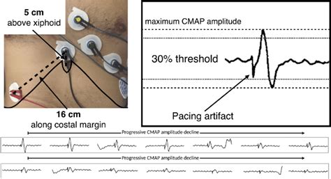 Phrenic Nerve Compound Motor Action Potential Cmap Monitoring Top