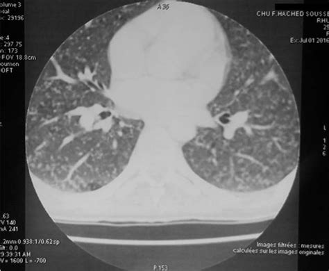 Thoracic Ct Scan Showing Diffuse Micronodular Involvement Of Infectious