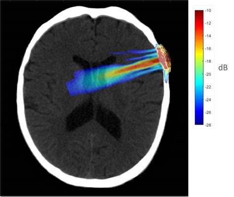 Frontiers Transcranial Focused Ultrasound To The Right Prefrontal