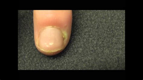 A Finger Infection Near The Nail Bed Or Paronychia As It Is Called