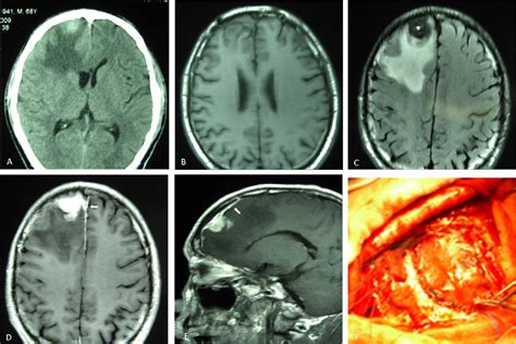 Imaging Characteristics Of Rosai Dorfman Disease In The Central Nervous