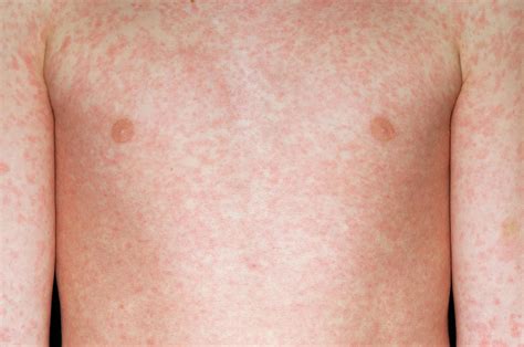Measles Rash Photograph By Dr P Marazziscience Photo Library