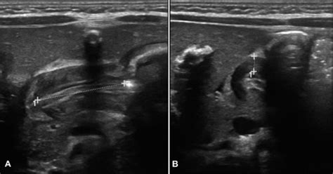 A Ultrasound Images In This Patient Show A Pyloric Muscle Length Of 20