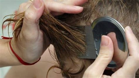 How To Kill Head Lice In 10 Steps Cbc News