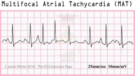Ecg Multifocal Atrial Tachycardia Hot Sex Picture