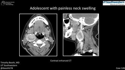 Adolescent With Painless Neck Swelling American Society Of Pediatric