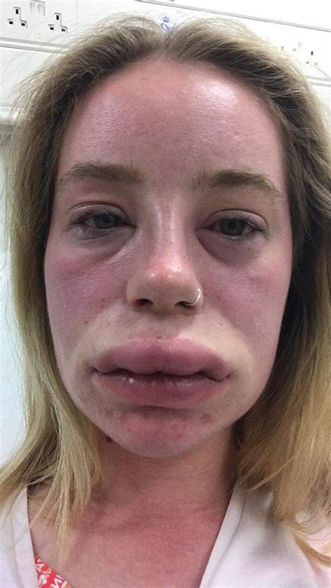 Fox News Woman Left Suffering From Swollen Lips Full Body Rash For