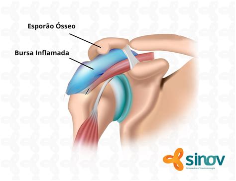 Bursite E Tendinite Do Ombro Dr Jo O Manoel Fonseca Filho