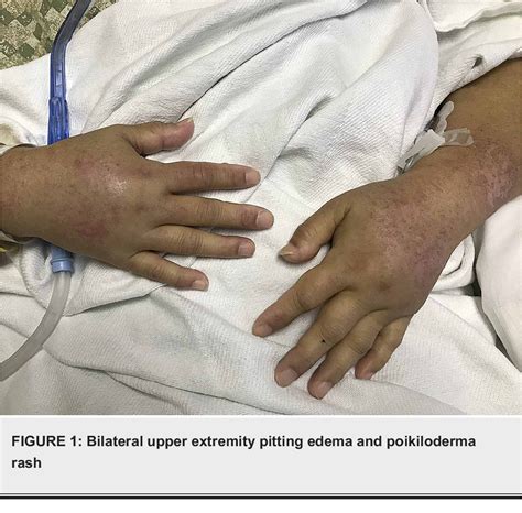 Figure 1 From Unusual Bilateral Upper Extremity Pitting Edema In A