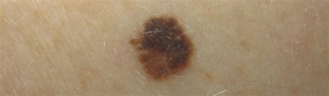 11 Skin Cancer Symptoms You Should Never Ignore Molemap Australia