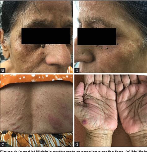Figure 1 From Paraneoplastic Eosinophilic Dermatosis In A Case Of