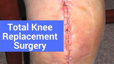 What Happens After Total Knee Replacement Surgery Total Knee Replacement Knee Replacement