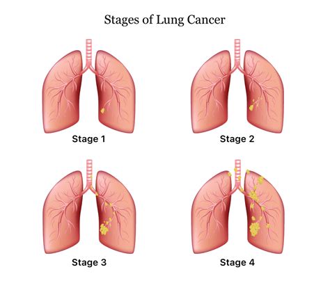 Lung Cancer Symptoms Causes Treatment And Survival Rates