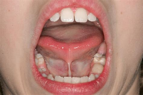 Abnormal Frenum Attachments In Children Homeopathic Dentistry