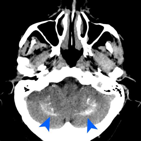 Axial Ct Scan Showing Bilateral Calcifications In In Both Hemispheres