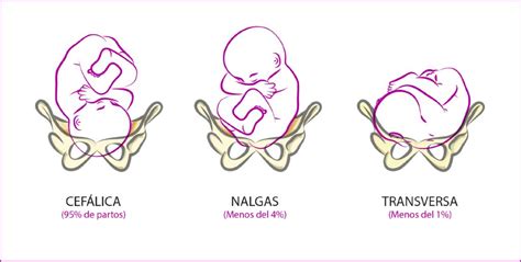 versión cefálica externa evita cesáreas si tu bebé viene de nalgas maternidadfacil
