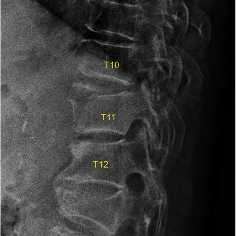 Pdf A Rare Hyperextension Injury In Thoracic Spine Presenting With
