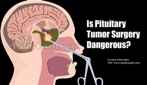 is pituitary tumor surgery dangerous tumor pituitary gland tumor surgery