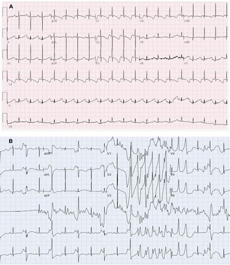 A The Initial Sinus Rhythm Lead Electrocardiogram Ecg And Rhythm