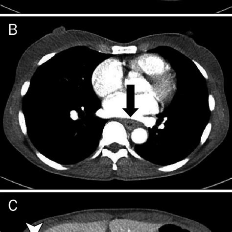A Computed Tomography Scan Showed A Enlarged Superior Mediastinal