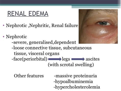 Clinical Features Of Edema