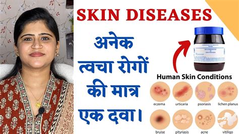 One Medicine For All Skin Diseases ॥अनेक त्वचा रोगों की मात्र एक दवा