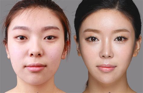 Asian Celebrities Plastic Surgery Before And After Pictures 2018