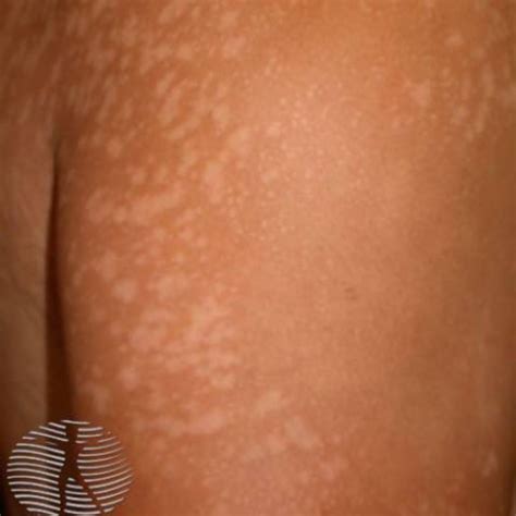 Best Treatments For Tinea Versicolor Skin Infection