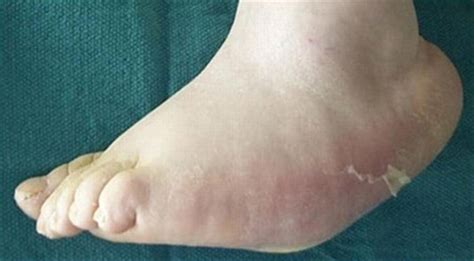 Charcot Foot Treatment In Pune Dr Chetan Oswal