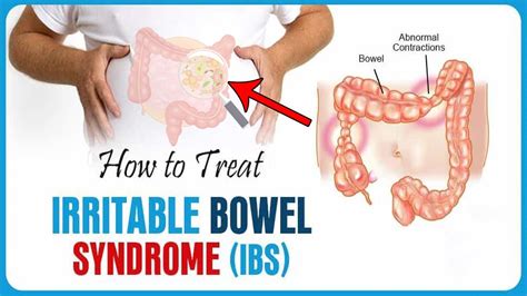 How To Treat Irritable Bowel Syndrome Fast At Home Home Remedies For Ibs Treatment Youtube