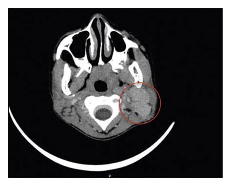 A Neck Ultrasound Shows Enlarged Left Cervical Lymph Node Compressing