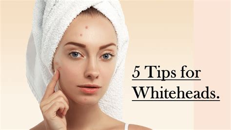 5 Tips For Removing Whiteheads Youtube